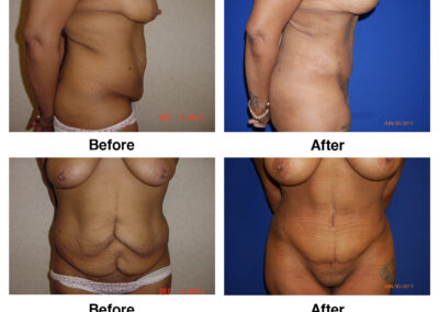 Abdominoplasty Tummy Tuck