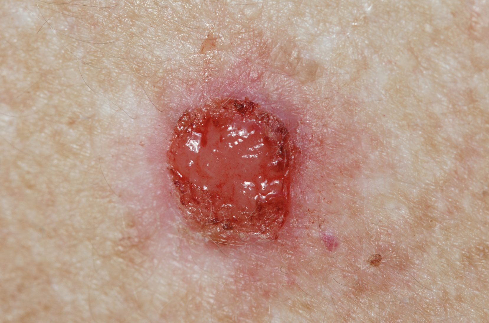 dermatology and surgery associates Basal cell carcinoma on skin bronx ny dermatology and surgery associates Basal cell carcinoma on skin bronx ny