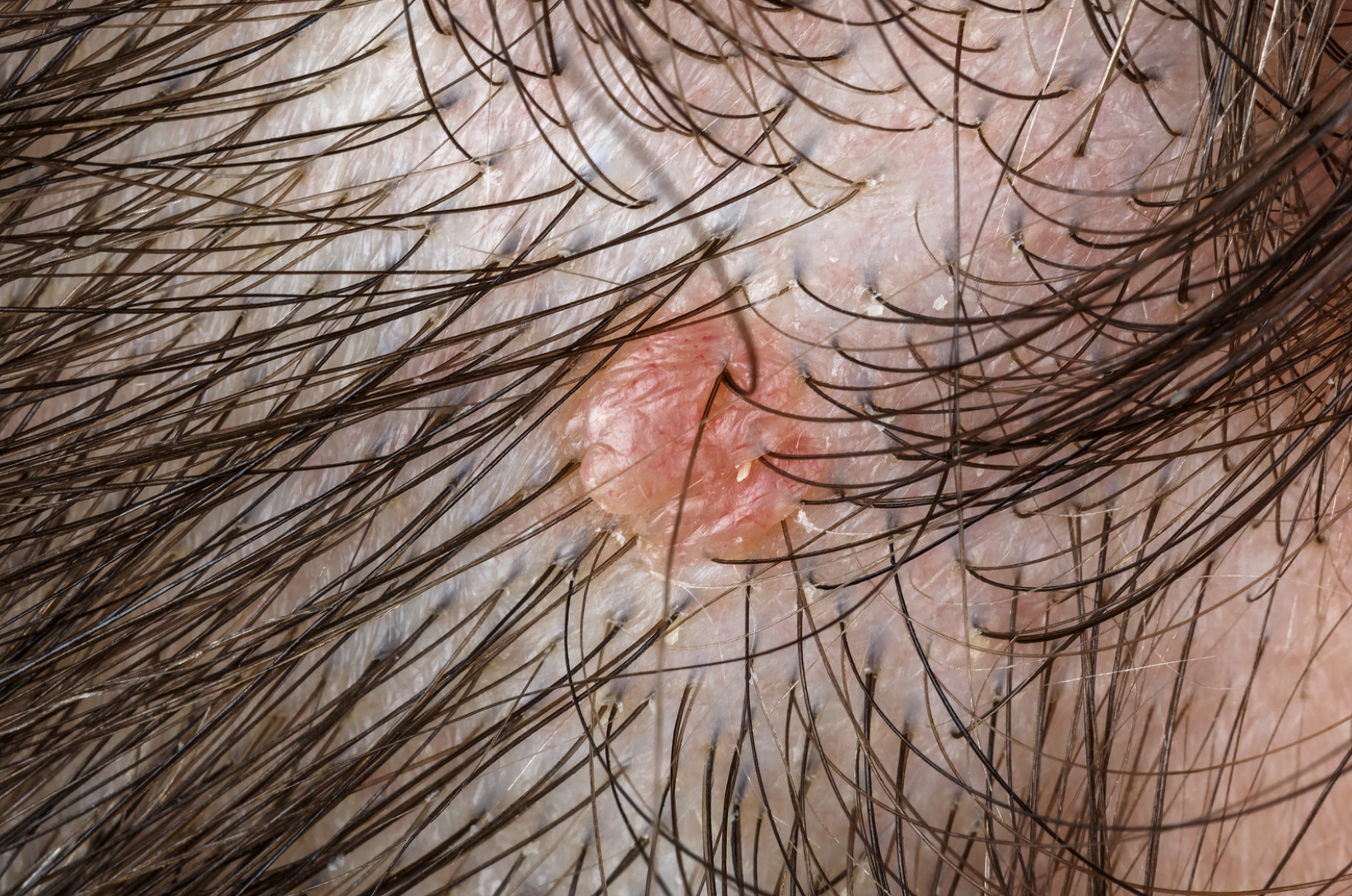 dermatology and surgery associates Basal cell carcinoma on head bronx ny dermatology and surgery associates Basal cell carcinoma on head bronx ny