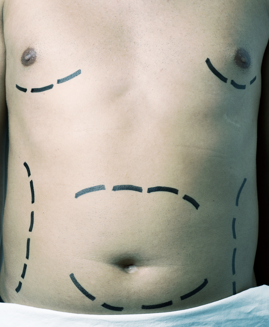 dermatology-surgery-associates-dsa-bronx-ny-body-procedures-1 dermatology surgery associates body procedures bronx ny
