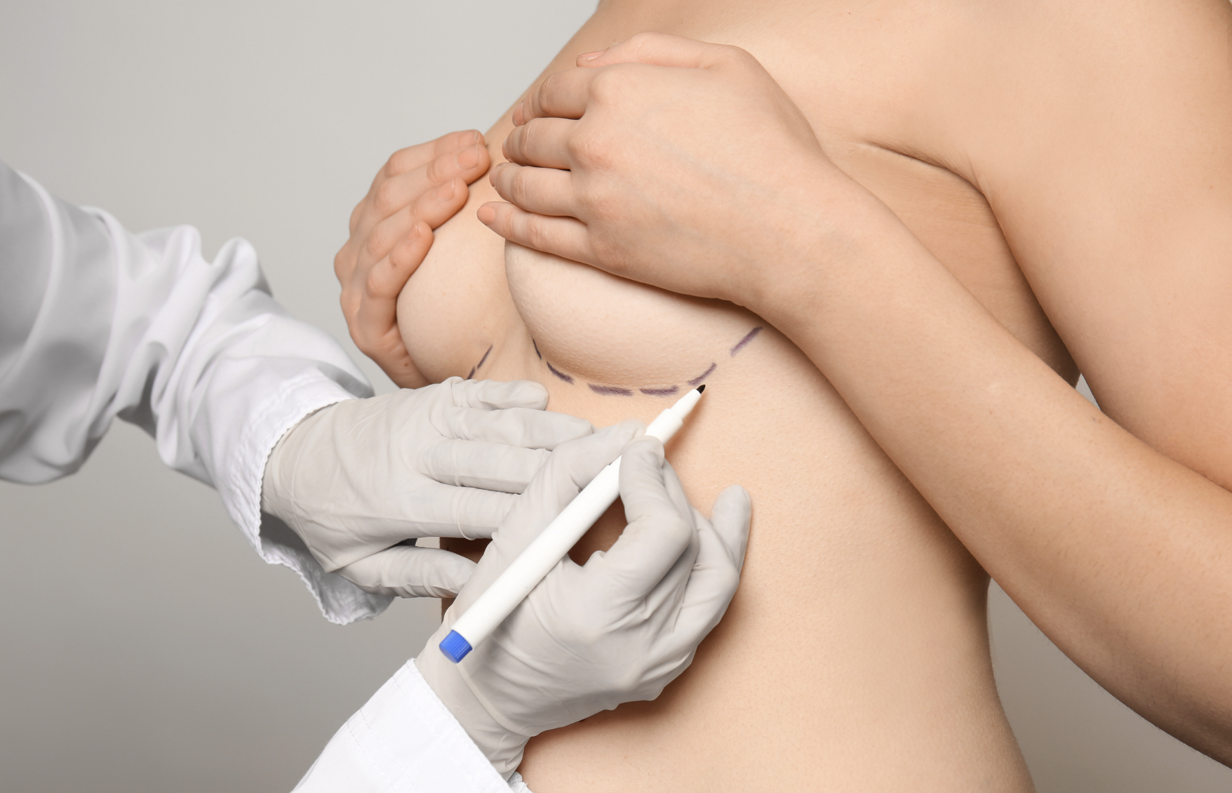 dermatology-surgery-associates-dsa-bronx-ny-breast-lift-1
