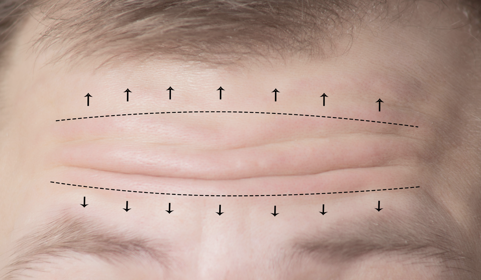 dermatology-surgery-associates-dsa-bronx-ny-forehead-lift-1