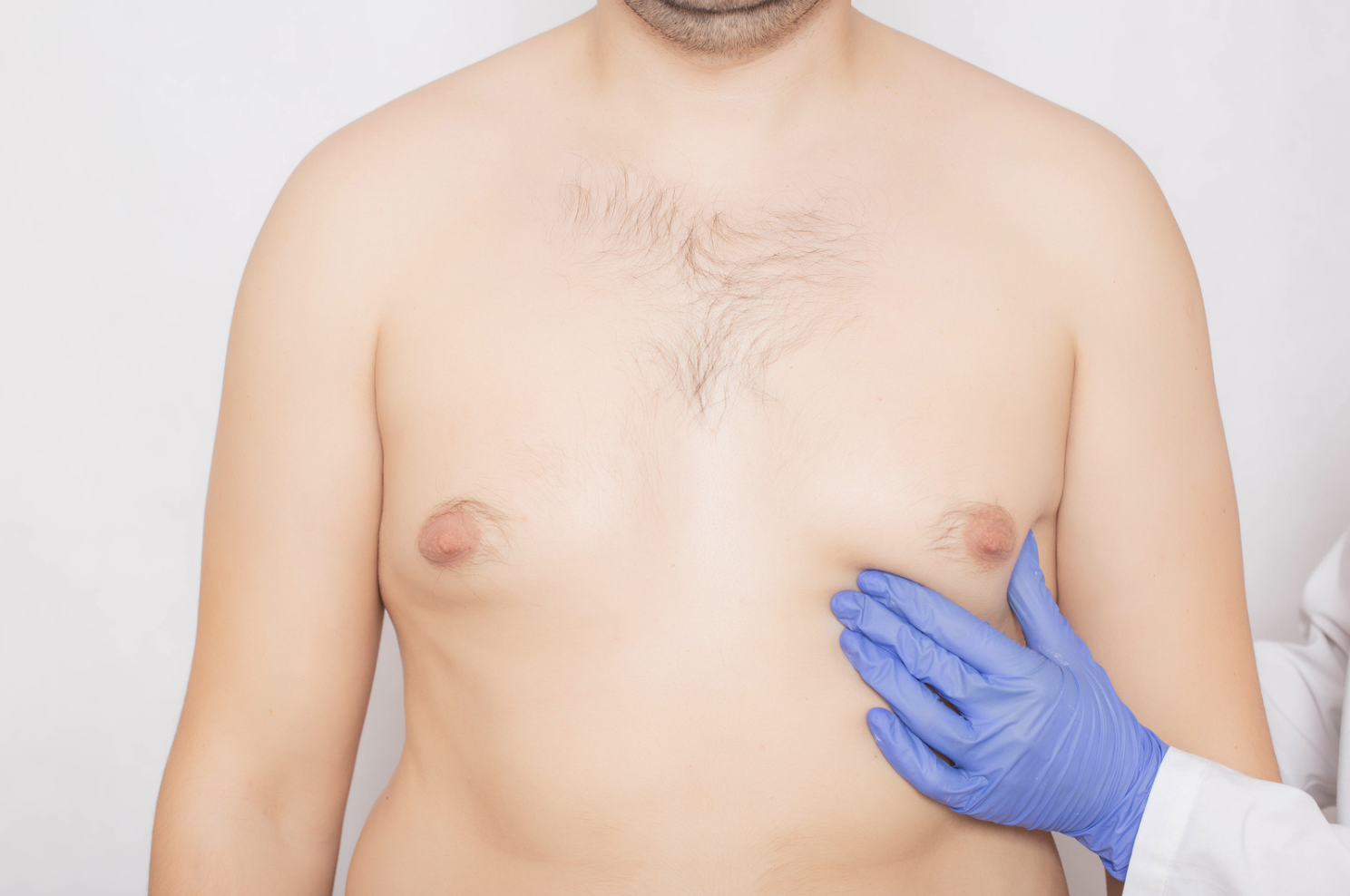 dermatology-surgery-associates-dsa-bronx-ny-male-breast-reduction