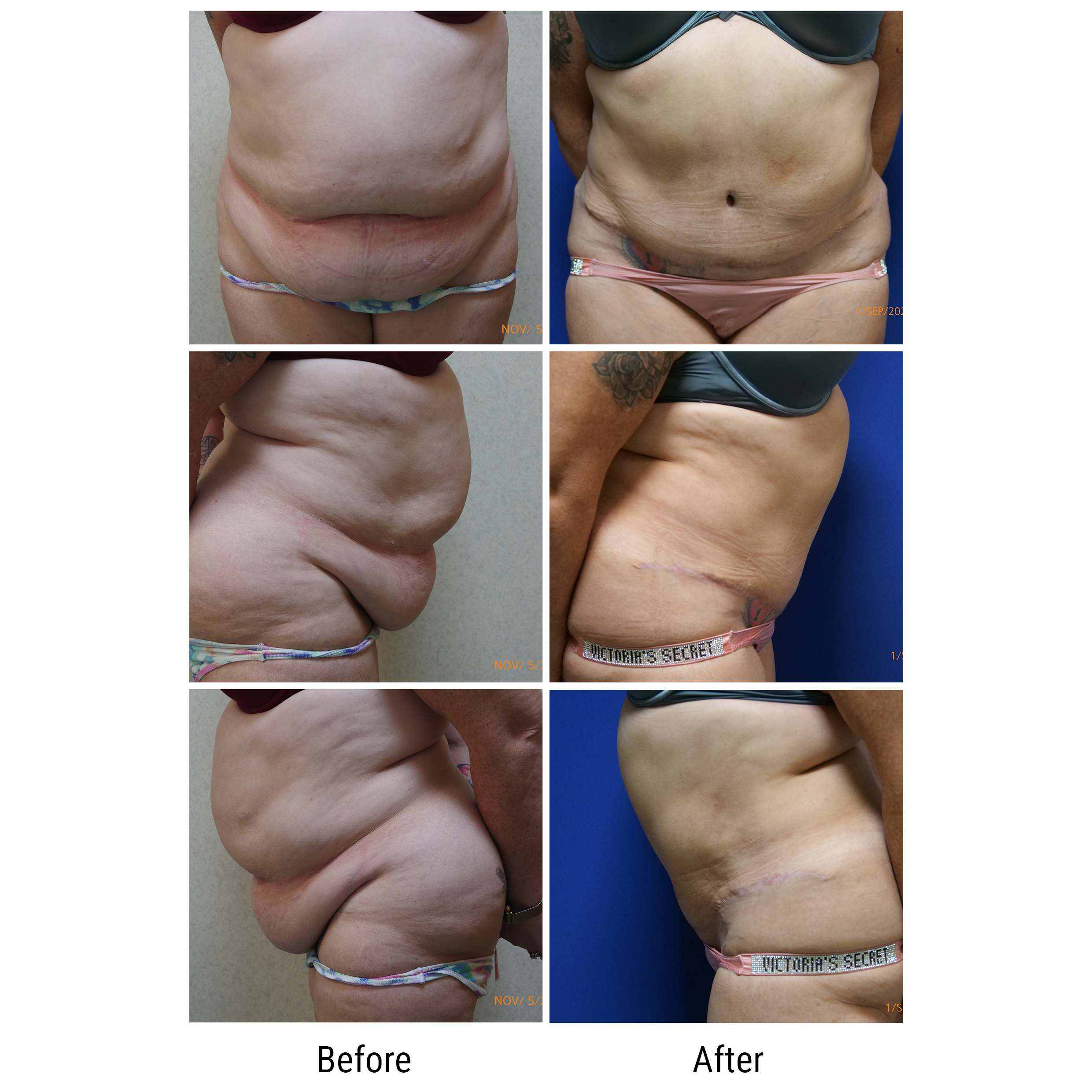 dermatology and surgery associates tummy tuck liposuction before and after bronx ny dermatology and surgery associates tummy tuck liposuction before and after bronx ny