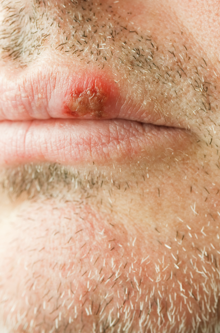 dermatology surgery associates cold sore on front of lip bronx new york city ny dermatology surgery associates cold sore on front of lip bronx new york city ny