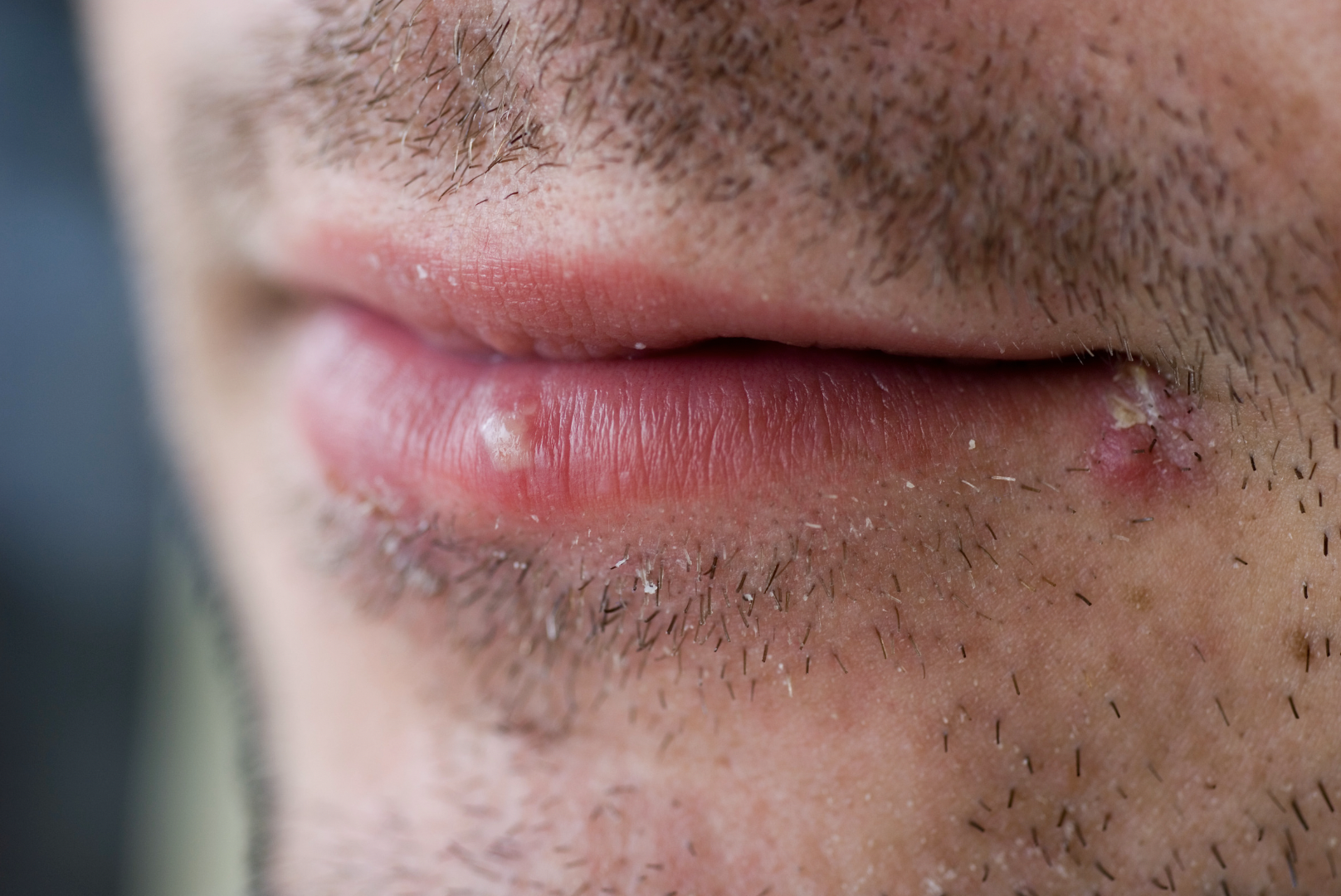 dermatology surgery associates cold sore on lip bronx new york city ny dermatology surgery associates cold sore on lip bronx new york city ny