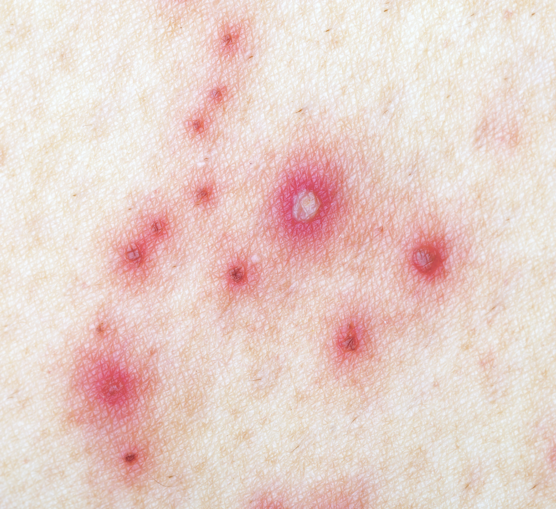 dermatology and surgery associates signs of herpes on skin bronx ny dermatology and surgery associates signs of herpes on skin bronx ny