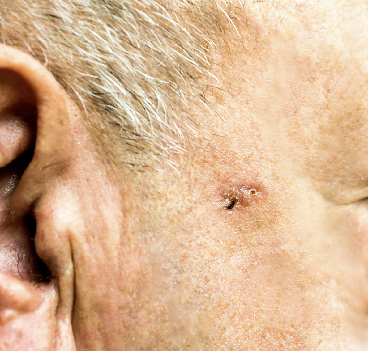 dermatology-surgery-associates-dsa-squamous-cell-carcinoma-1