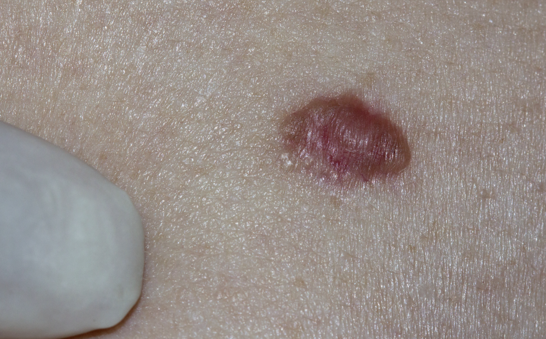 dermatology-surgery-associates-dsa-squamous-cell-carcinoma