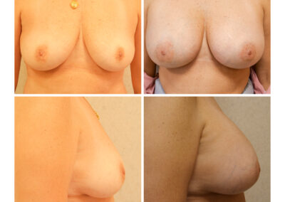 Breast Augmentation