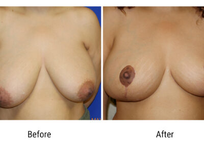 Breast Augmentation