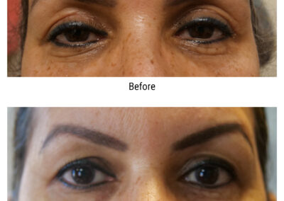 Blepharoplasty