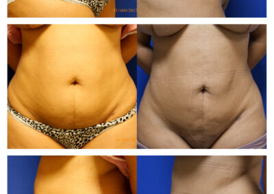 Liposuction