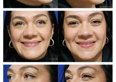Dimples