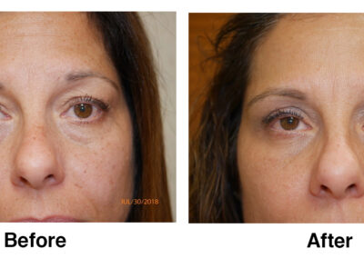 Blepharoplasty