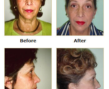 Facelift