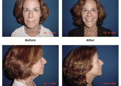 Facelift