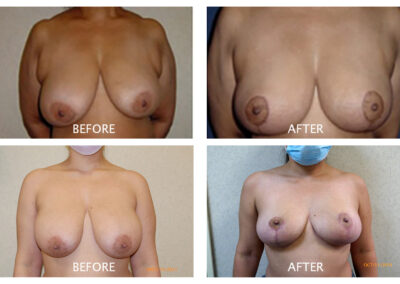 Breast Reduction