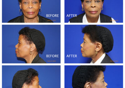 Facelift