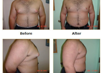 Male Breast Reduction Gynecomastia