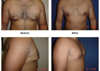 Male Breast Reduction Gynecomastia