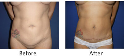 Liposuction