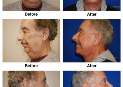 Male Facelift