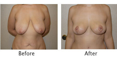Mastopexy Breast Lift
