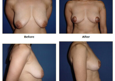 Mastopexy Breast Lift