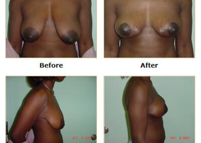 Mastopexy Breast Lift
