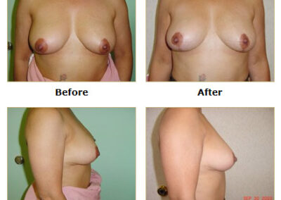 Mastopexy Breast Lift