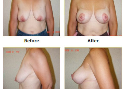 Mastopexy Breast Lift