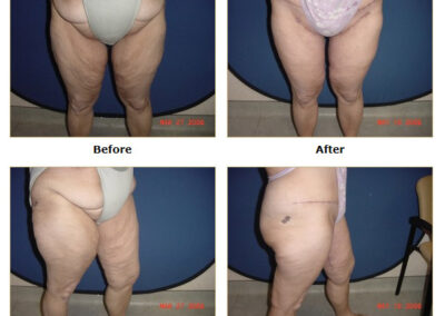 Medial Thigh Lift
