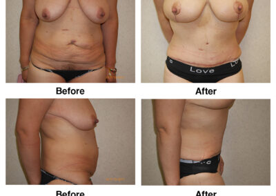 Abdominoplasty Tummy Tuck