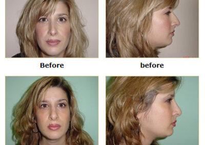 Rhinoplasty