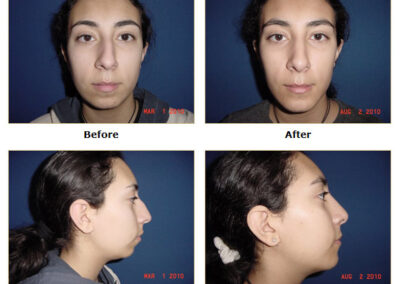 Rhinoplasty