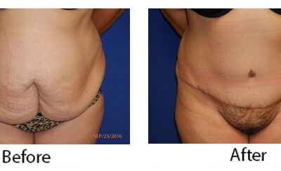 Abdominoplasty Tummy Tuck