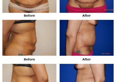 Abdominoplasty Tummy Tuck