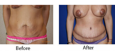 Abdominoplasty Tummy Tuck