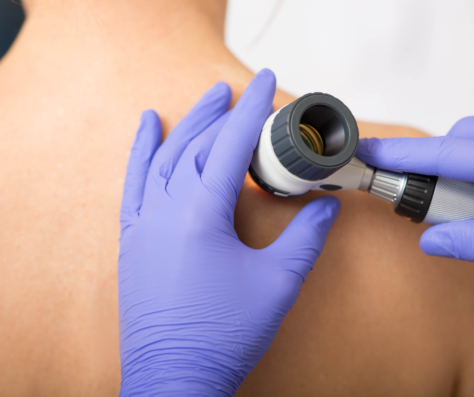 Dermatofibrosarcoma-protuberans-dfsp-dermatology-and-surgery-associates-bronx-new-york-1