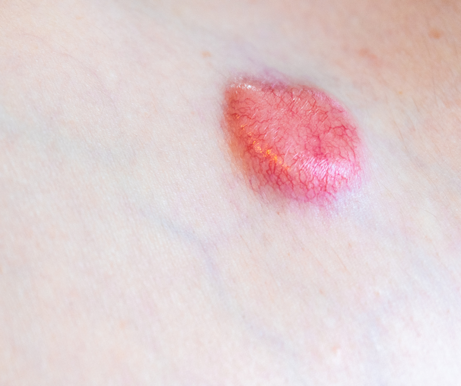Dermatofibrosarcoma-protuberans-dfsp-dermatology-and-surgery-associates-bronx-new-york-2 dermatology surgery associates Dermatofibrosarcoma protuberans bronx ny