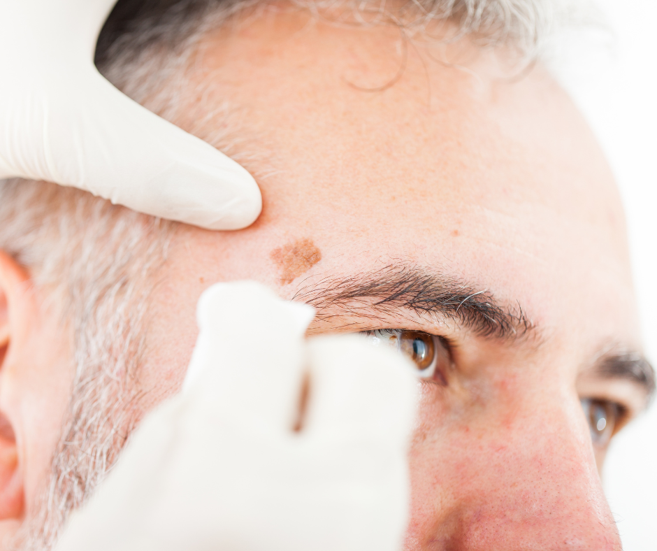 age-spots-dermatology-and-surgery-associates-bronx-new-york-1 dermatology surgery associates age spots bronx new york