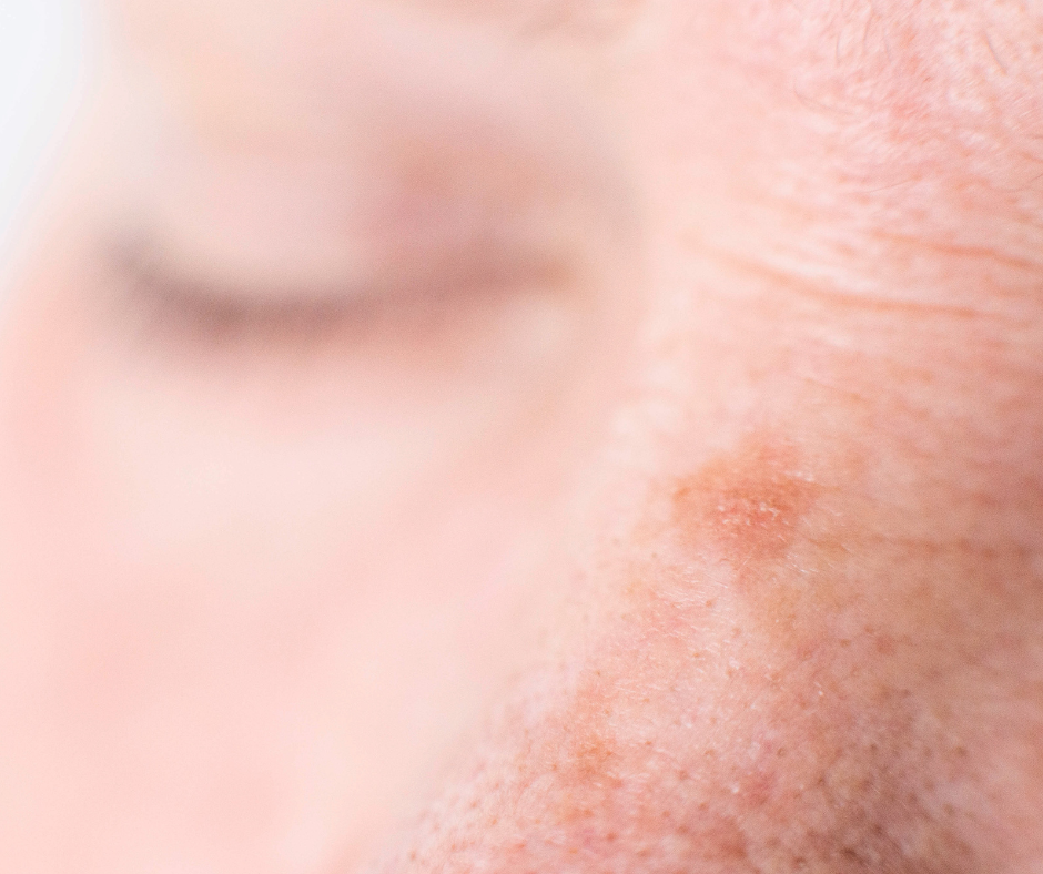 age-spots-dermatology-and-surgery-associates-bronx-new-york-2 dermatology surgery associates age spot on nose bronx new york
