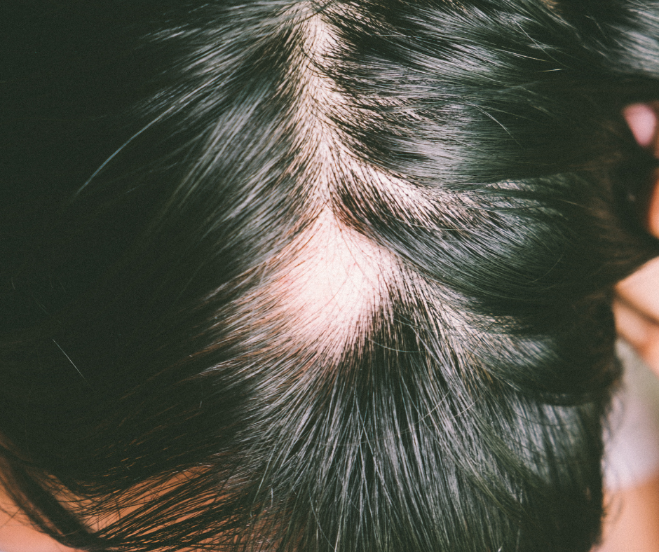 alopecia-areata-dermatology-and-surgery-associates-bronx-new-york-1 dermatology and surgery associates alopecia areata top of head bronx ny