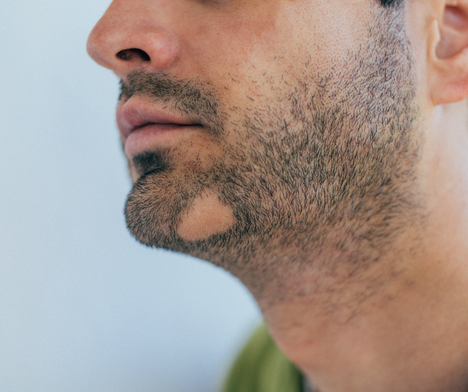 alopecia-areata-dermatology-and-surgery-associates-bronx-new-york-2 alopecia areata on chin bronx new york
