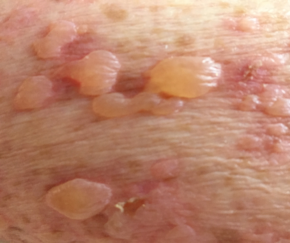 bullous-pemphigoid-dermatology-and-surgery-associates-bronx-new-york-1