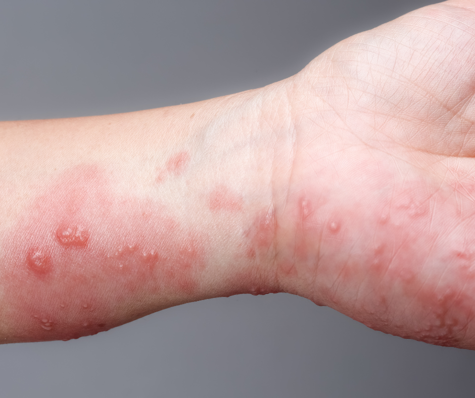 bullous-pemphigoid-dermatology-and-surgery-associates-bronx-new-york-2