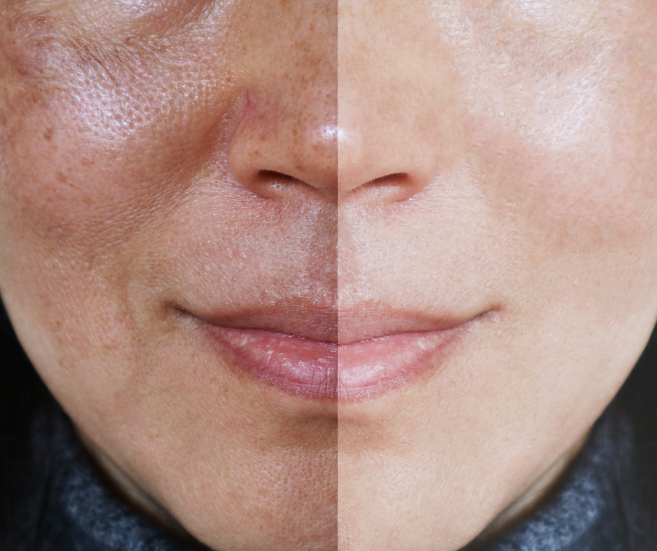 melasma-dermatology-and-surgery-associates-bronx-new-york-1