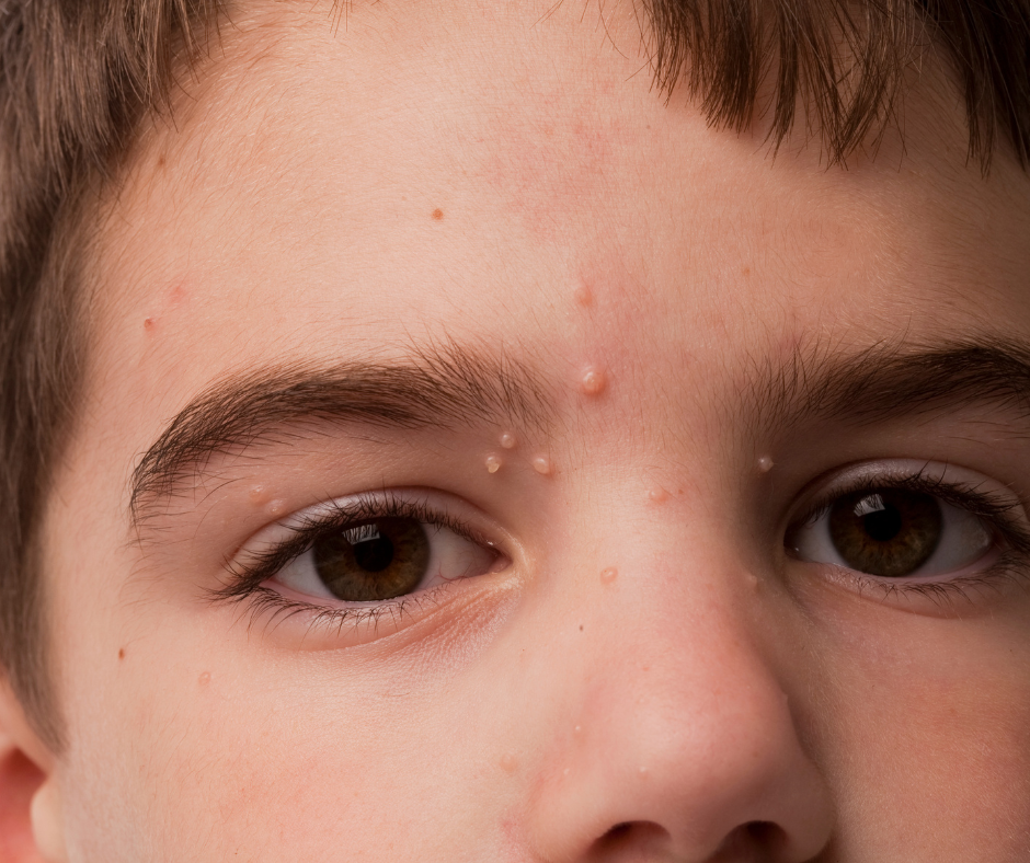 molluscum-dermatology-and-surgery-associates-bronx-new-york-1 dermatology and surgery associates mollouscum around face bronx new york