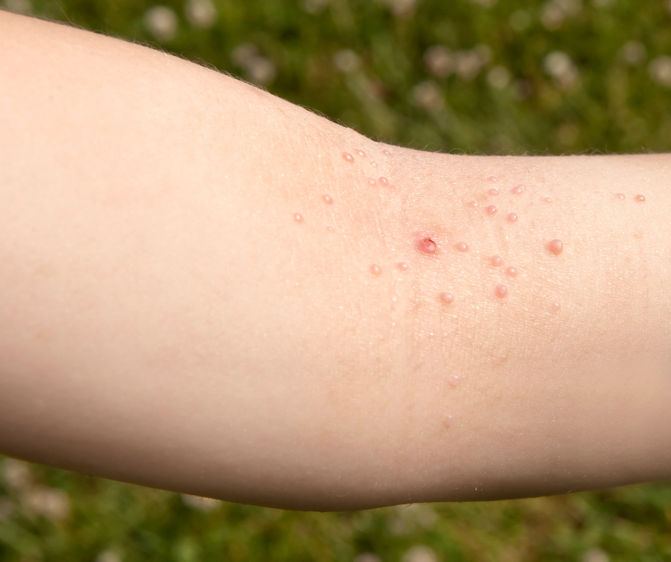 molluscum-dermatology-and-surgery-associates-bronx-new-york-2 dermatology and surgery associates molluscum on arm bronx new york